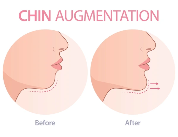 Chin Augmentation
